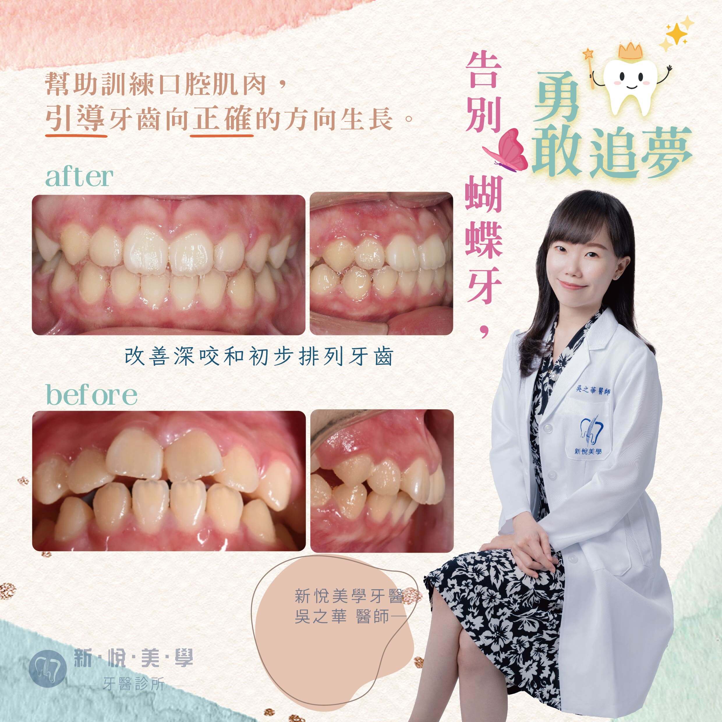 新悅美學牙醫案例-告別蝴蝶牙，勇敢追夢的第1張圖片